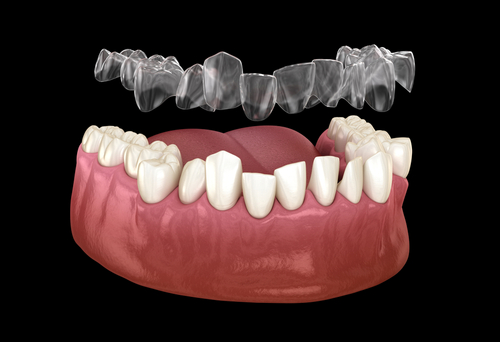 Clear aligner above a bottom row of teeth.