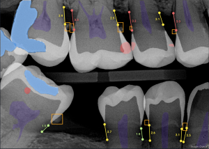overjet x-rays